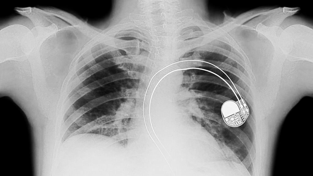 I Just Received A Pacemaker.  Can I Still Weld?
